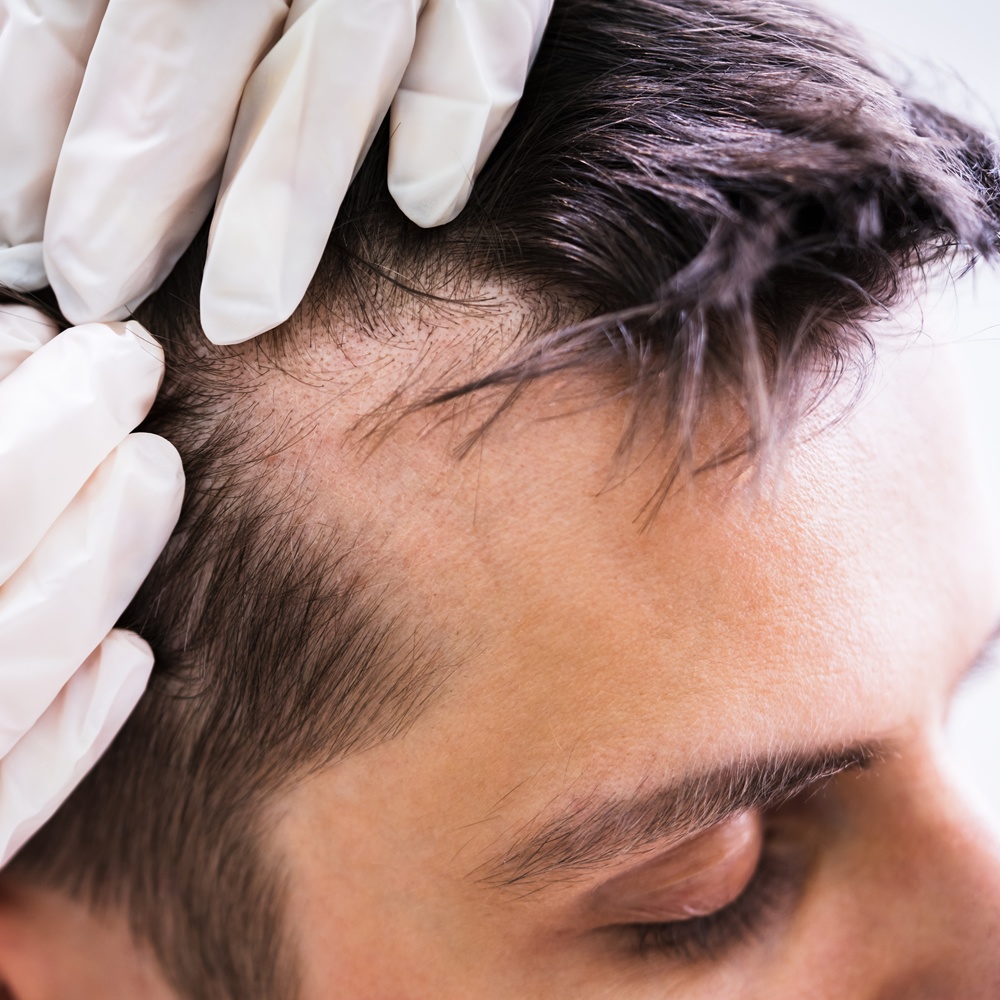 Low Level Laser Therapy for Hair Loss | Hair Rejuvenation Clinic UK