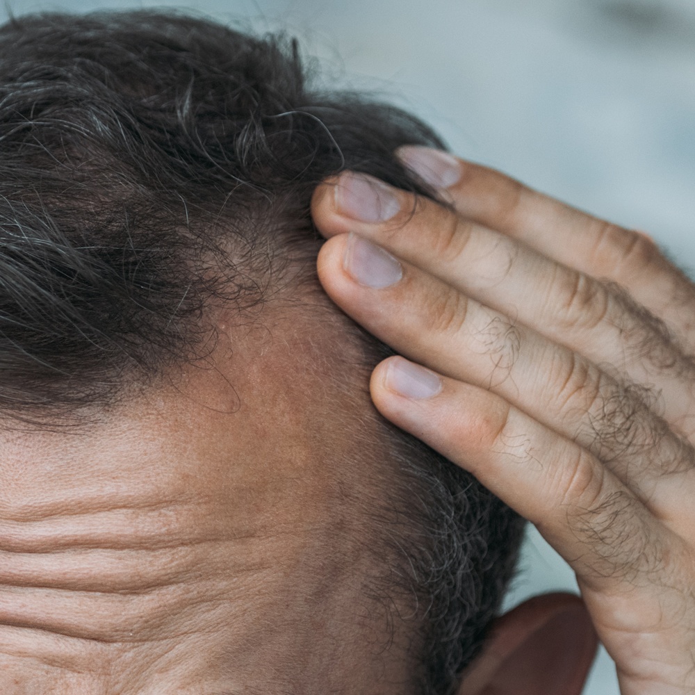 Hair Replacement Systems for men